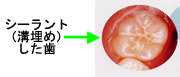 シーラント(溝埋め)した歯の写真