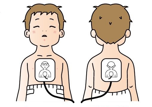乳児に貼られた電極パッドの図