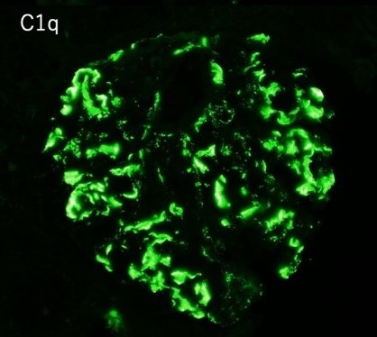 C1q nephropathyの糸球体:蛍光抗体法
