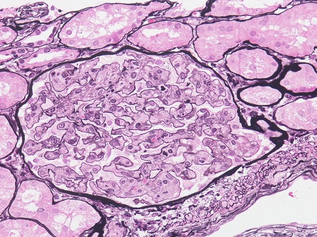 TAFRO症候群のglomerular endotheliosis、PAM-HE染色