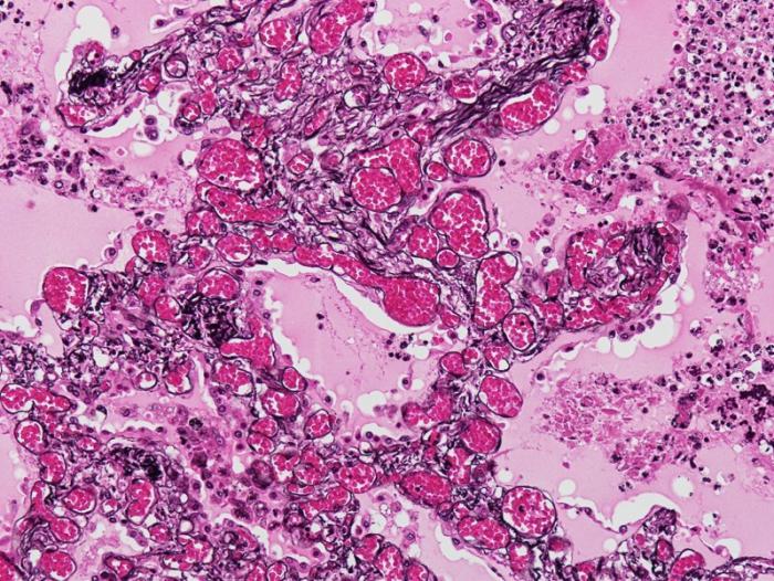 pulmonary capillary hemangiomatosis、剖検肺、PAM-HE染色