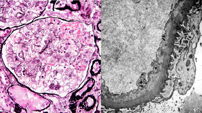 Thrombotic microangiopathy, 左:PAM-HE、右:電子顕微鏡×12,000