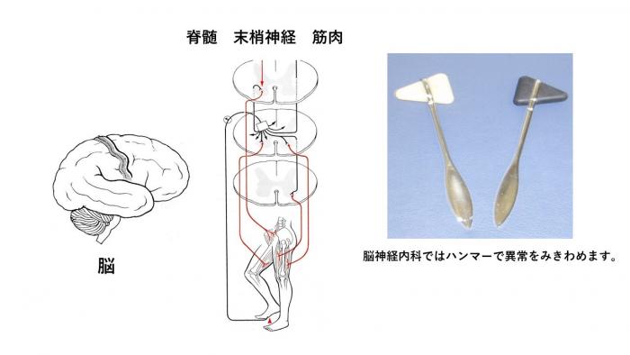 脳神経内科ではハンマーで異常をみきわめます。