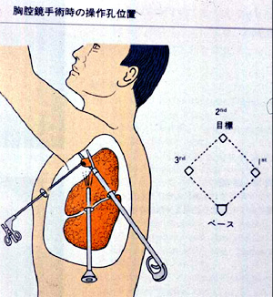 胸腔鏡手術操作の基本1