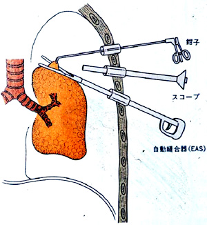 胸腔鏡手術操作の基本2